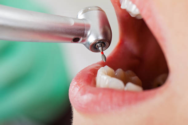 Best Broken or Cracked Tooth Emergency Dentist in St George, UT